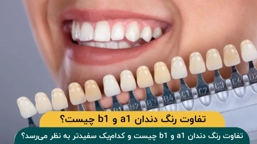 تفاوت-رنگ-دندان-a1-و-b1